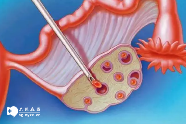 取卵后肚子大但不痛，原因解析与恢复策略