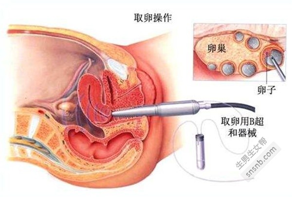 试管取卵过程中的注意事项——关于不能佩戴手镯的重要性探讨