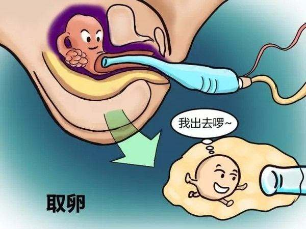 关于取卵过程，疼痛与舒适并存的管理策略
