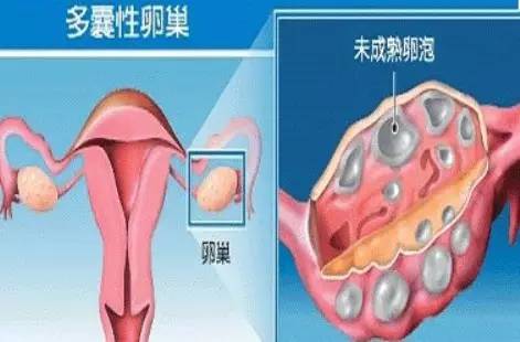 取卵后小腹硬，一种常见现象及其解析